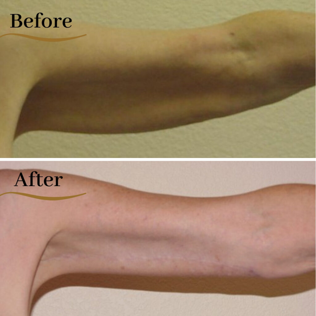 Arm Lift - Jersey City, Hoboken, Paramus - Brachioplasty