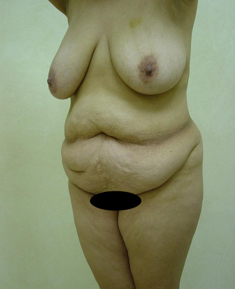 Abdominoplasty 01 Patient Before