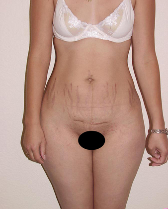 Abdominoplasty 03 Patient Before