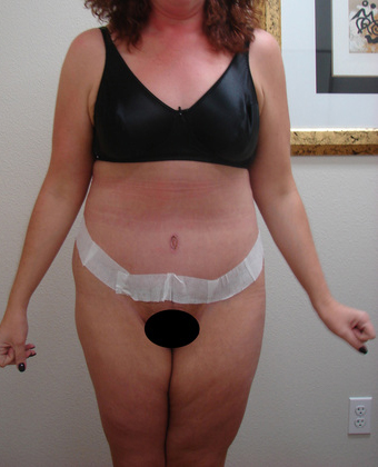 Abdominoplasty 04 Patient After