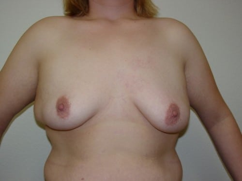 Breast Augmentation 12 Patient Before