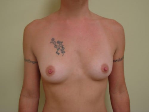 Breast Augmentation 13 Patient Before