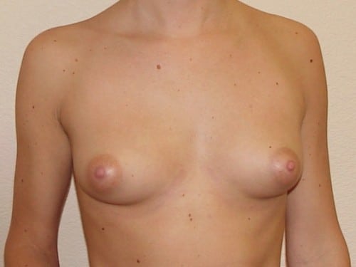 Breast Augmentation 15 Patient Before
