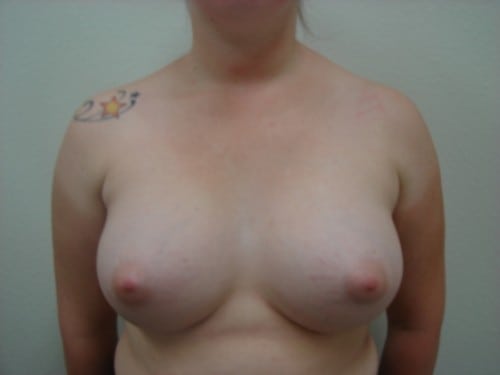 Breast Augmentation 17 Patient After