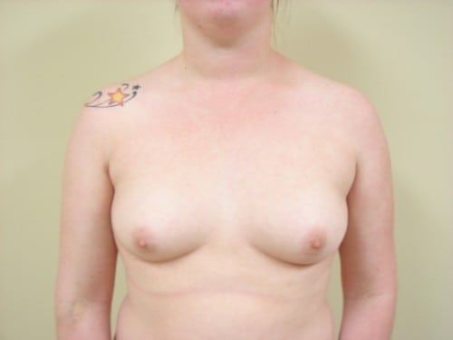 Breast Augmentation 17 Patient Before