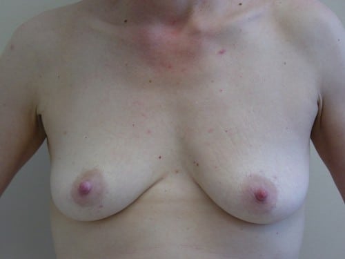 Breast Augmentation 18 Patient Before
