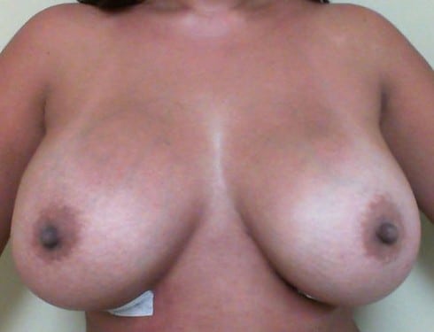 Breast Augmentation 24 Patient After