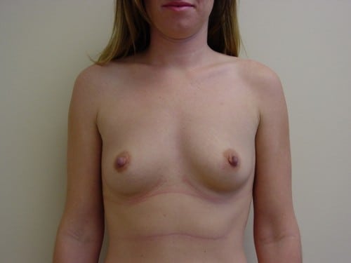 Breast Augmentation 05 Patient Before