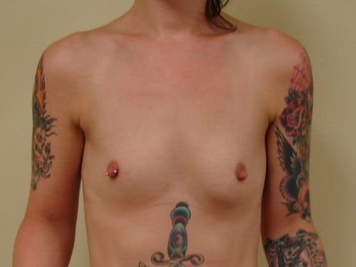 Breast Augmentation 07 Patient Before