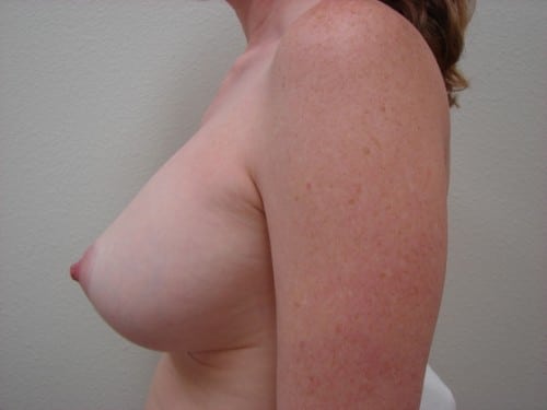 Breast Implants 10 Patient After