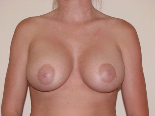 Breast Implants 11 Patient After