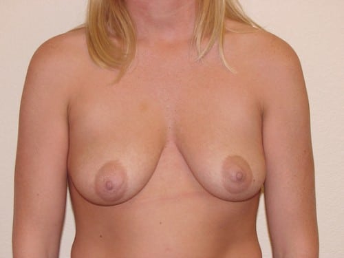 Breast Implants 11 Patient Before