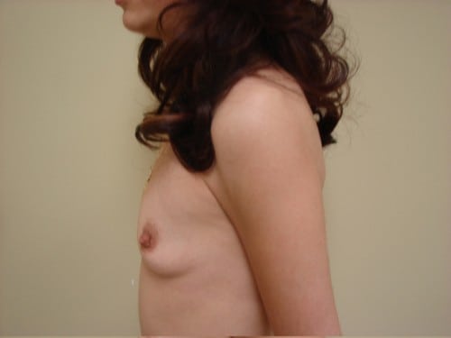 Breast Implants 13 Patient Before