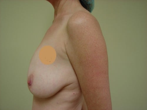 Breast Implants 15 Patient Before