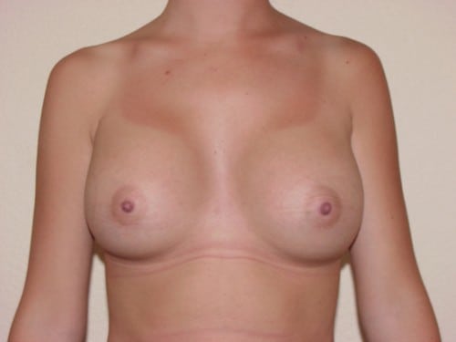 Breast Implants 16 Patient After