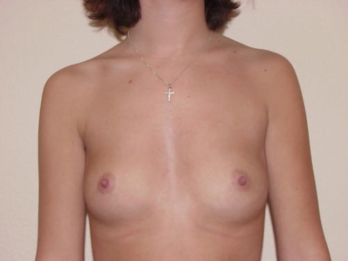 Breast Implants 16 Patient Before