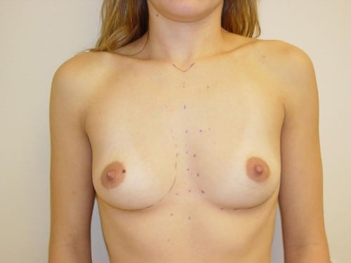 Breast Implants 20 Patient Before