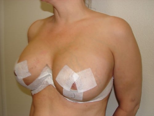 Breast Implants 23 Patient After