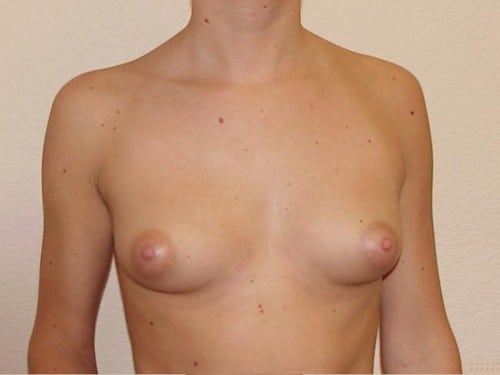 Breast Implants 09 Patient Before
