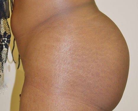 Brazilian Butt Lift 01 Patient After