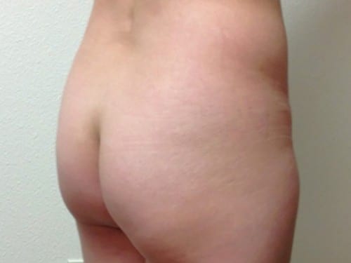 Brazilian Butt Lift 10 Patient Before