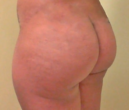 Brazilian Butt Lift 11 Patient Before