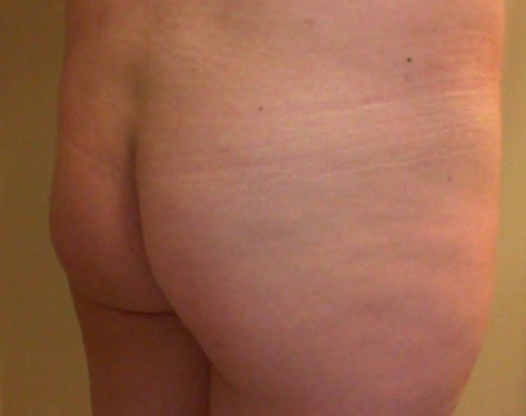 Brazilian Butt Lift 12 Patient Before