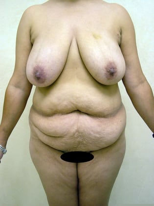 Breast Lift 12 Patient Before