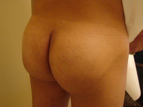 Brazilian Butt Lift 02 Patient After