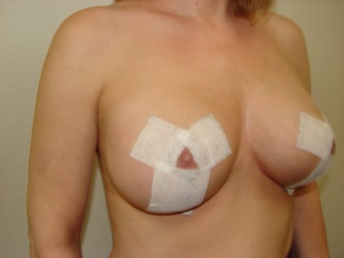 Breast Lift 02 Patient After