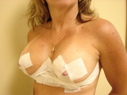 Breast Lift 03 Patient After