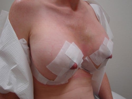 Breast Lift 05 Patient After