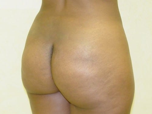 Brazilian Butt Lift 06 Patient After