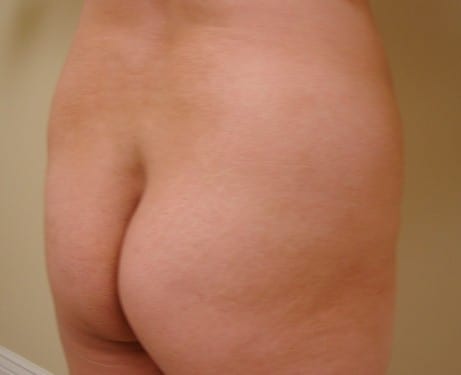 Brazilian Butt Lift 07 Patient Before