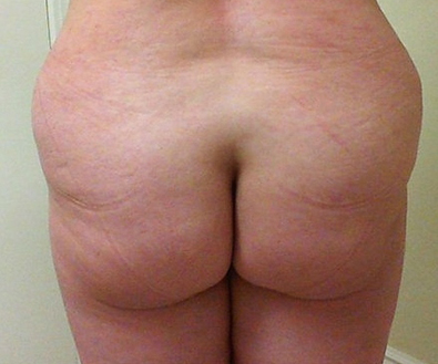 Brazilian Butt Lift 03 Patient Before