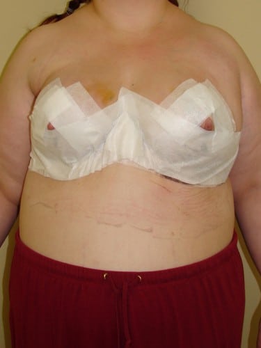 Breast Reduction 06 Patient After