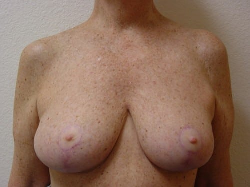 Breast Reduction 07 Patient After