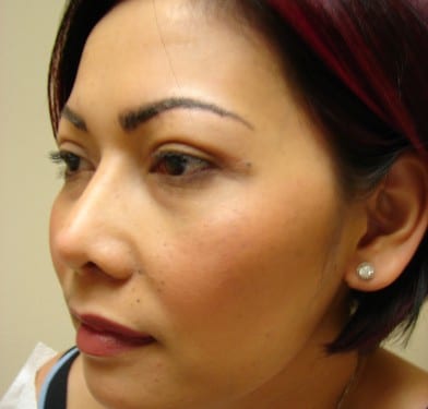 Blepharoplasty 01 Patient After