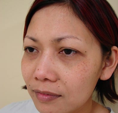 Blepharoplasty 01 Patient Before