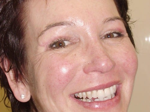 Blepharoplasty 10 Patient After