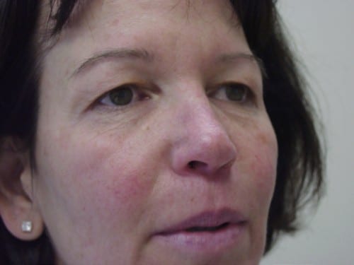 Blepharoplasty 10 Patient Before