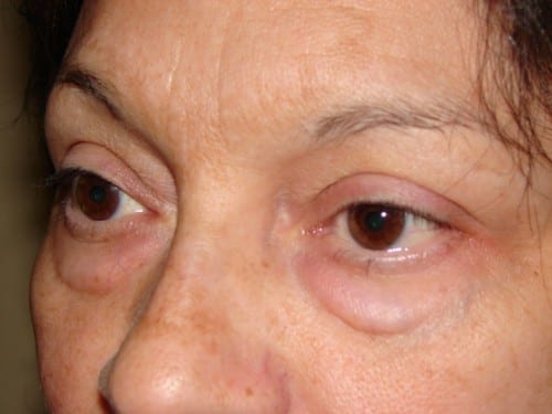 Blepharoplasty 11 Patient Before