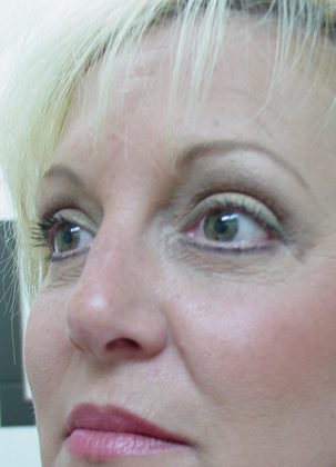 Blepharoplasty 12 Patient After