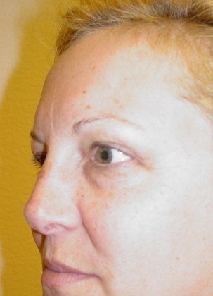 Blepharoplasty 12 Patient Before