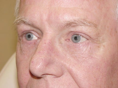 Blepharoplasty 13 Patient After