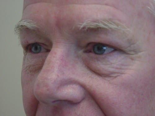 Blepharoplasty 13 Patient Before