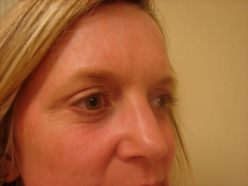 Blepharoplasty 14 Patient After