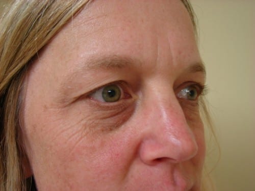 Blepharoplasty 14 Patient Before