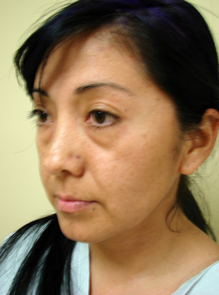 Blepharoplasty 15 Patient Before