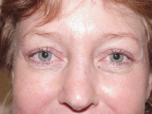 Blepharoplasty 02 Patient After